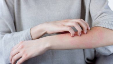 Eczema and Acne