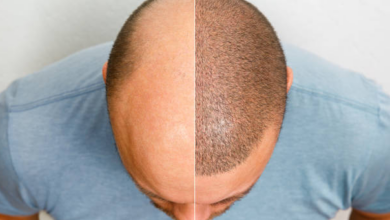 How Many Grafts Do You Need for a Hair Transplant in Turkey