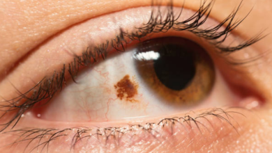 What Are Brown Spots in Your Eyes