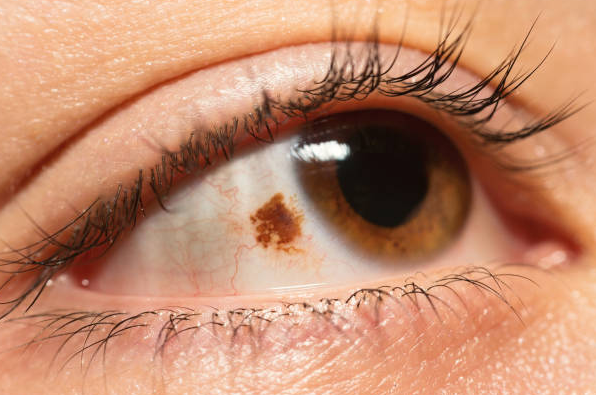 What Are Brown Spots In Your Eyes