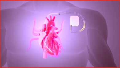 Is Pacemaker Implant in Kolkata Useful in Electrical Stimulation of the Heart?