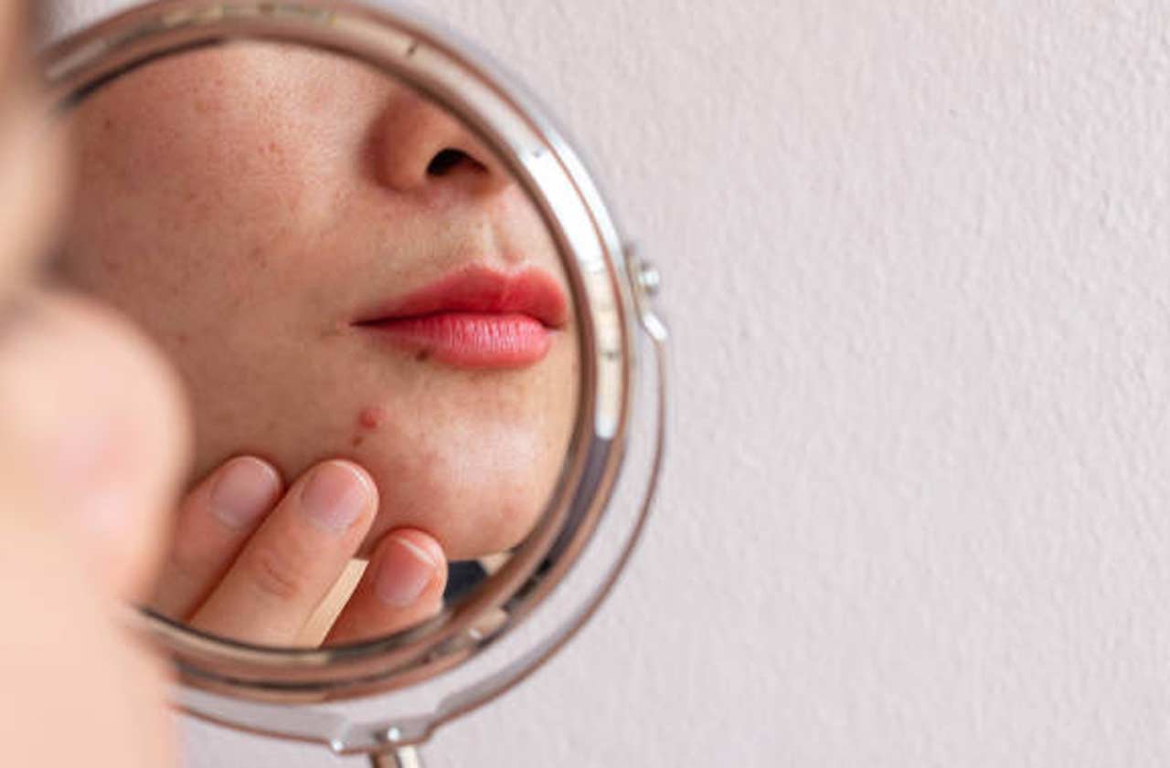 Pimple Scars Be Gone Find the Best Scar Removal Cream for Your Skin Type