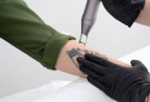 5 Common Myths and Misconceptions About Tattoo Removal