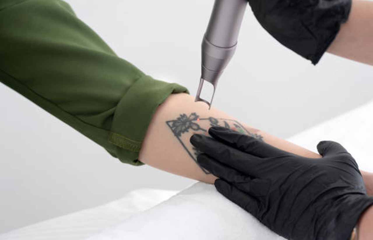 5 Common Myths and Misconceptions About Tattoo Removal