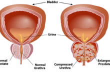 How to Identify and Manage Benign Prostatic Hyperplasia