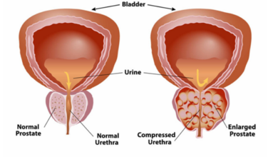 How to Identify and Manage Benign Prostatic Hyperplasia