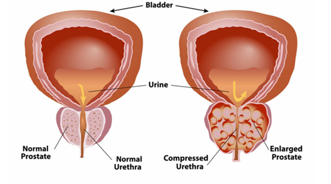 How to Identify and Manage Benign Prostatic Hyperplasia